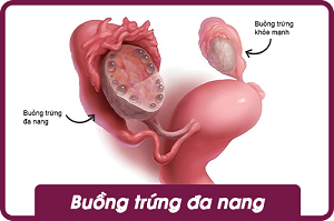 Buồng trứng đa nang sq women