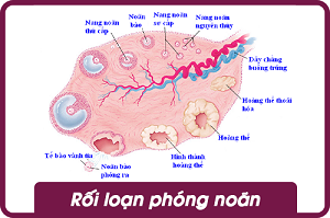 rối loạn phóng noãn sq women