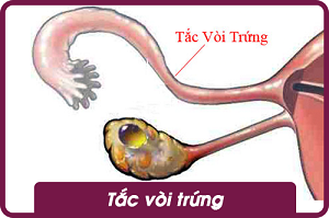 tắc vòi trứng sq women