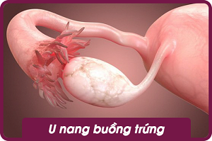 u nang buồng trứng sqwomen